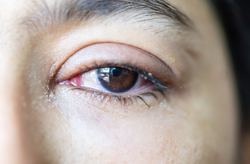 A close-up of a watery eye affected by conjunctivitis.