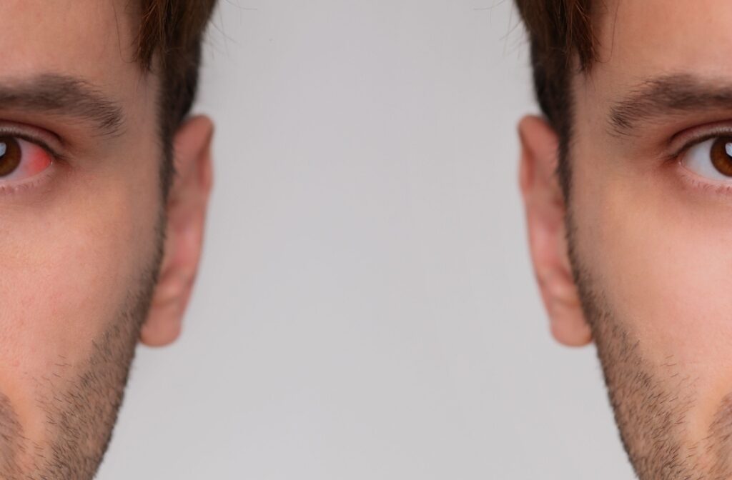 A mirror image of a man’s face on either side. On the left side, the man’s eye is red and itchy, while the right is normal.