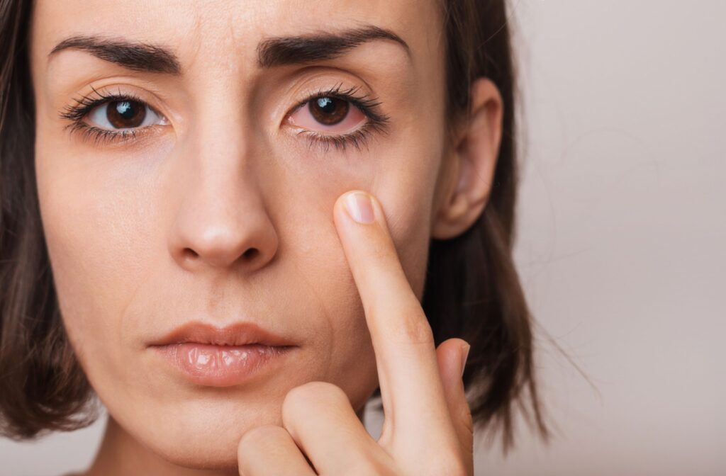 A close-up picture of a person pulling down their left eyelid to show the redness and irritation in their dry eyes.