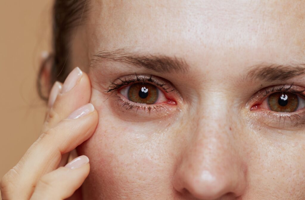 A close up of red, irritated eyes caused by dry eye