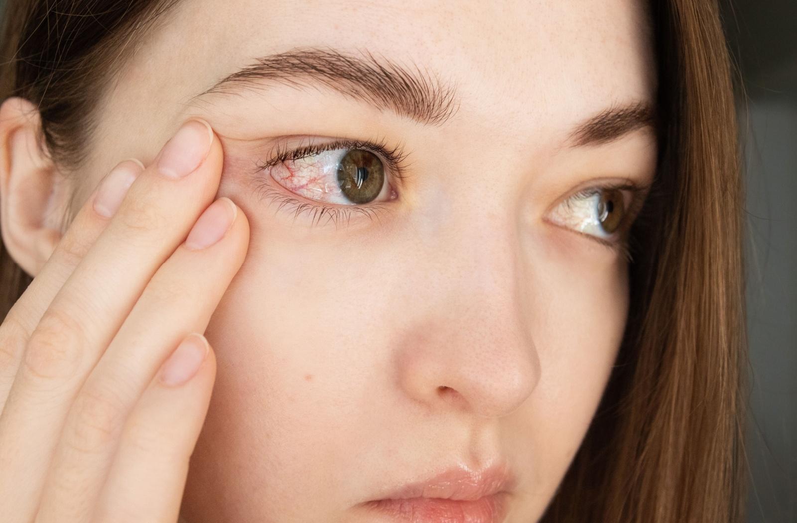 A person with a red irritated eye